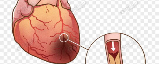 Depresión, ansiedad y riesgo de infarto